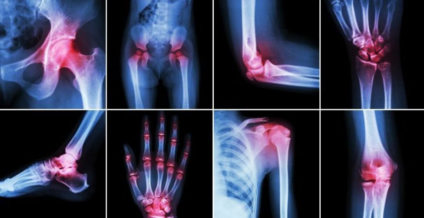 arthritis-pain.jpg
