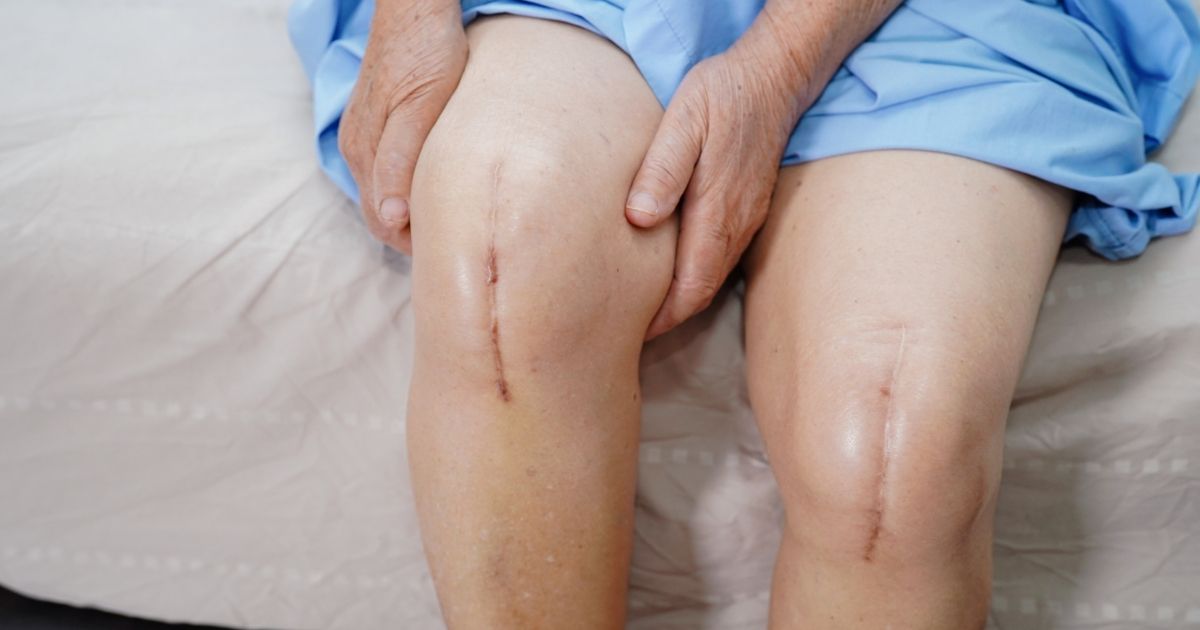 Patient has replaced his knee with stitches on his both knees.